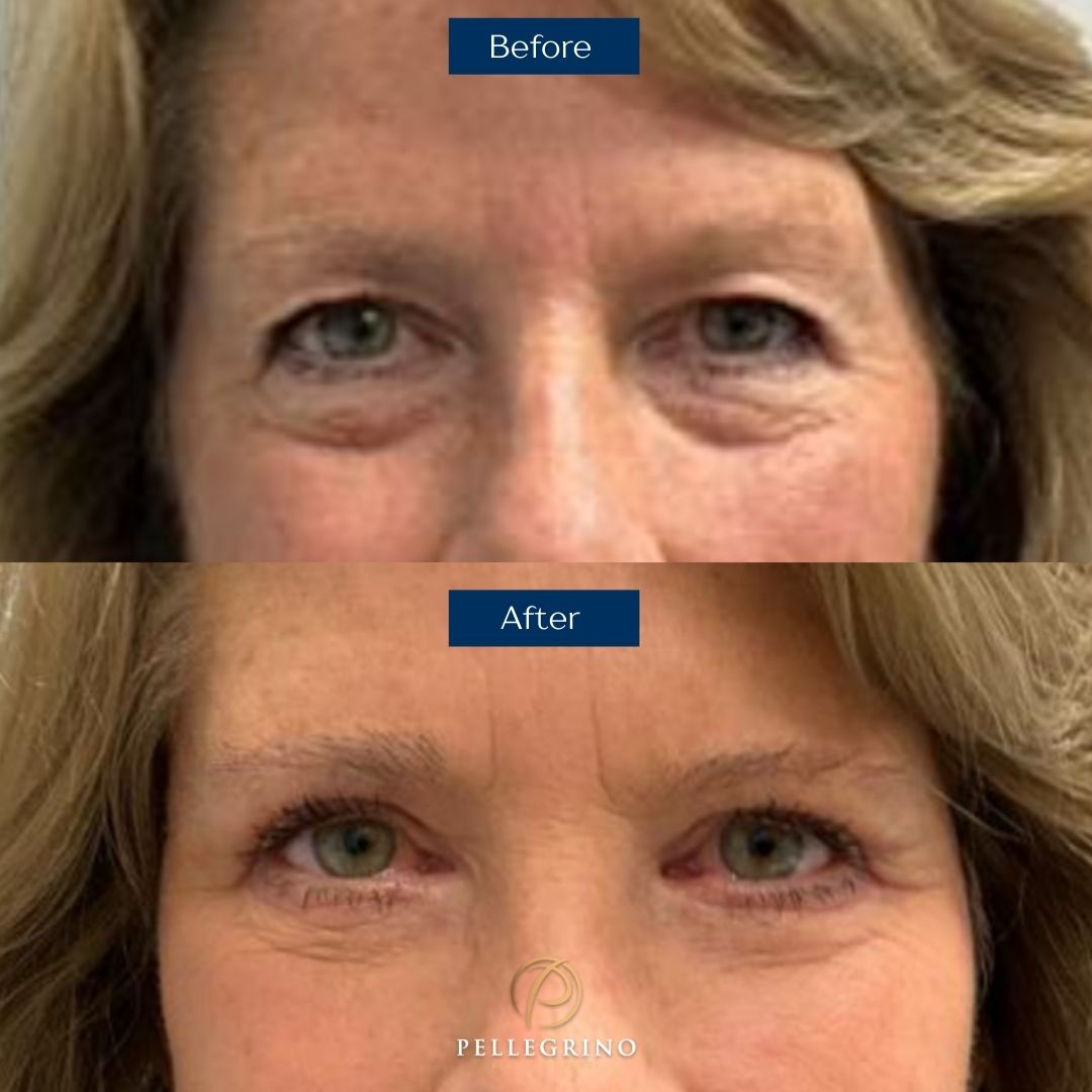 Upper and Lower Blepharoplasty Upper and Lower Blepharoplasty